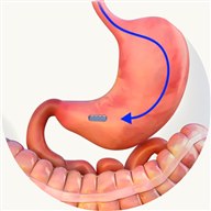 The first magnet passing into the stomach
