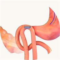 The two magnets holding the gut walls together